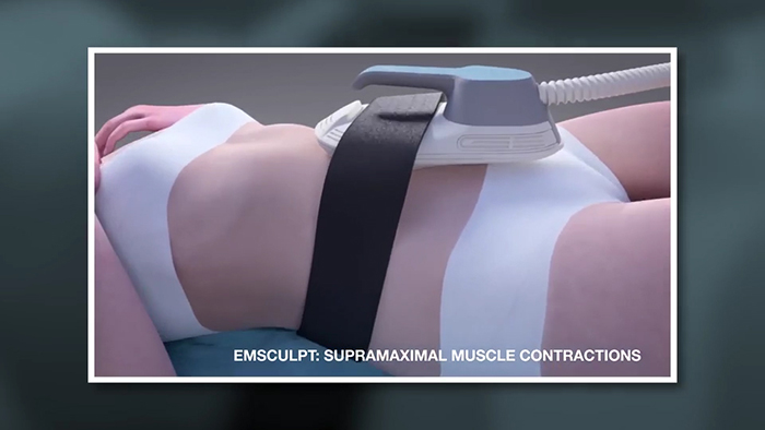 How Emsculpt works.