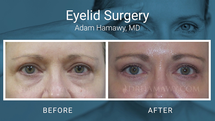 Eyelid Surgery Before and After - Hamawy.