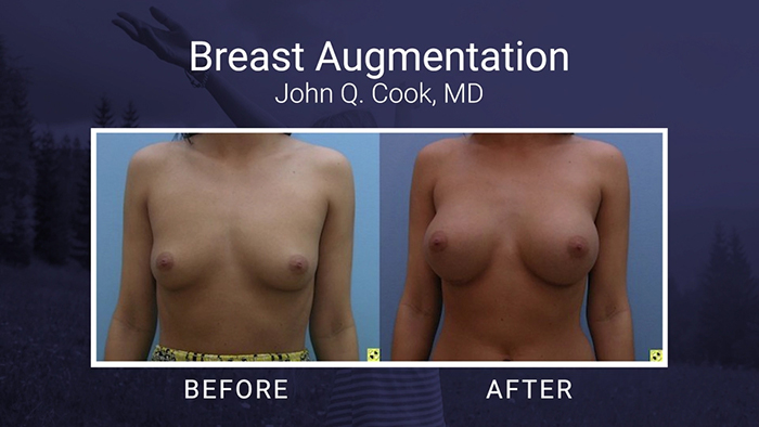 Breast Augmentation Results - Dr. Cook