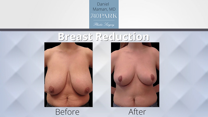 Breast reduction before and after - Maman.