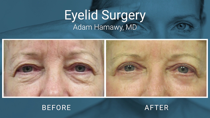 Eyelid Surgery Results - Hamawy.