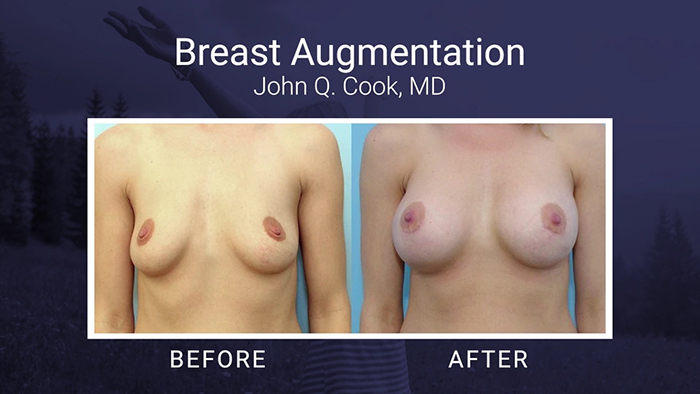 Breast Augmentation Before and Afters - Cook