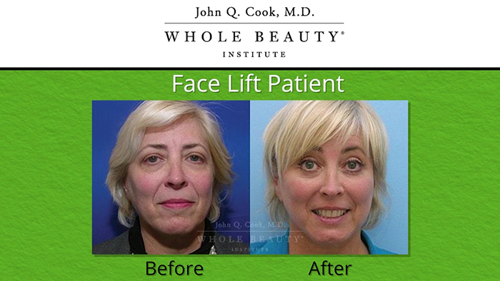 Facelift results - Dr. John Q. Cook.