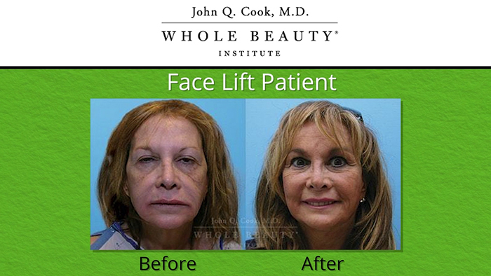 Triumphant facelift patient - Dr. Cook.