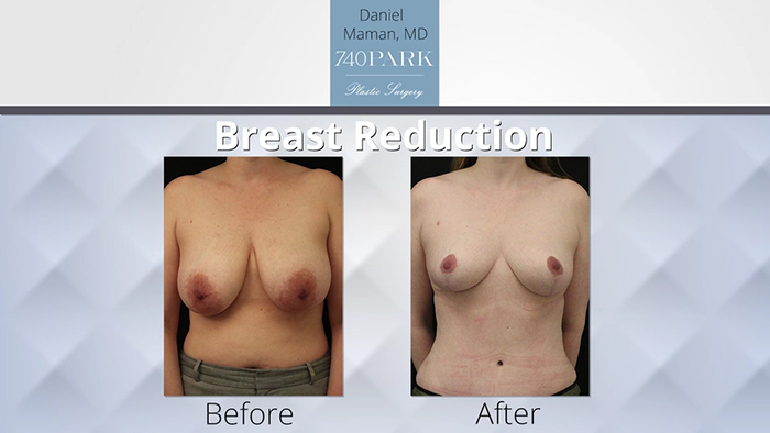 Breast reduction results - Dr. Maman.