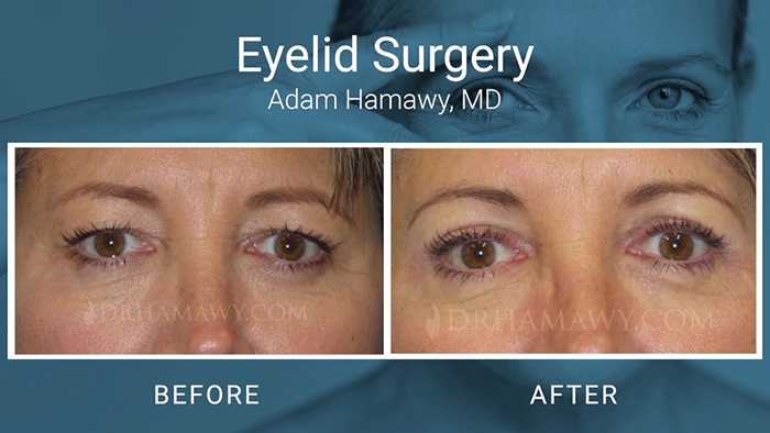 Eyelid surgery patient - Hamawy.