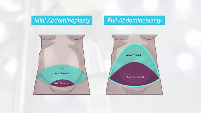 Midsection reboot - full and mini tummy tuck.