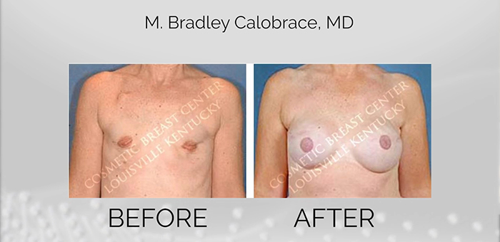 Before and After Breast Implant Removal