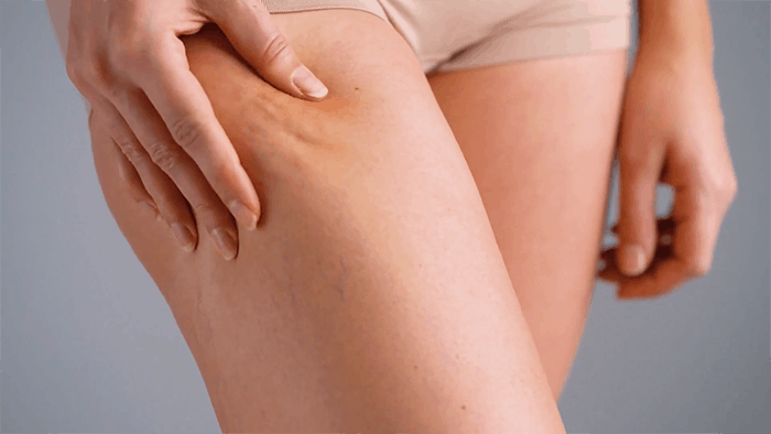 Using non-invasive devices for cellulite.