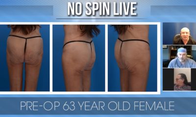 No Spin Live Episode 85 - Older Patient Buttock Augmentation Case